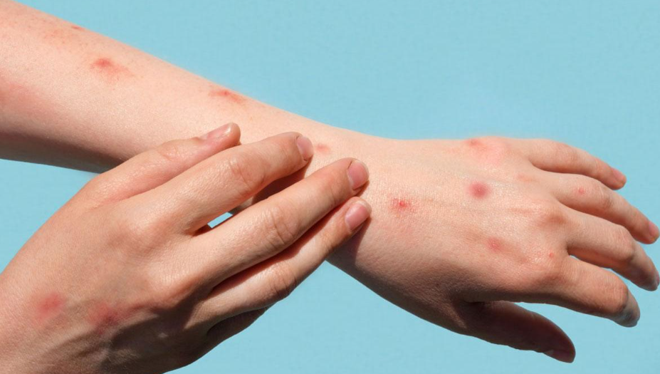 Yeni bela maymun çiçeği: 90 binden fazla kişi virüse yakalandı 156 kişi öldü